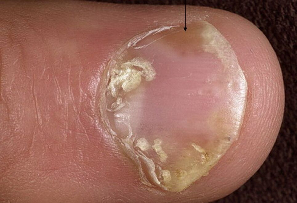 PDF] Onychomadesis Developed Only on the Nails Having Cutaneous Lesions of  Severe Hand-Foot-Mouth Disease | Semantic Scholar