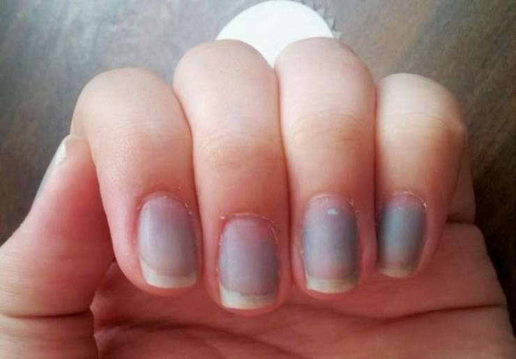 Blue and Purple Nail Beds or Nails: Causes and Diagnosis