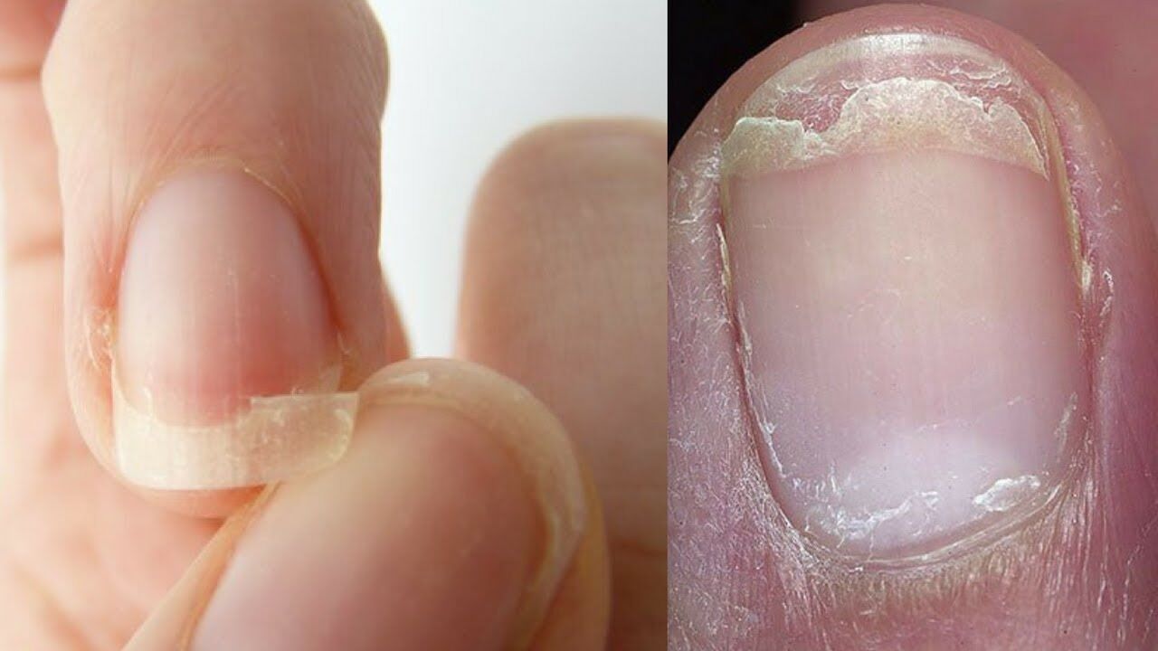 Nails in systemic disease  RCP Journals