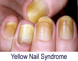 Nail problems - NHS