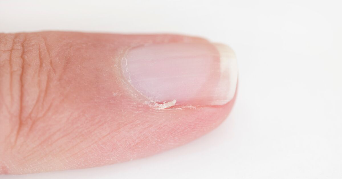 Fungal Nail Infections | Fungal Diseases | CDC