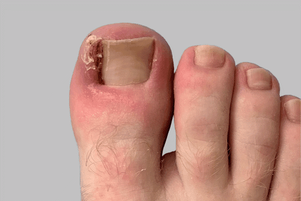 Nail diseases chart Pictures symptoms and treatments